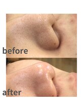 ミノア 大野城店(MINOA)/毛穴洗浄/毛穴の黒ずみ・開き