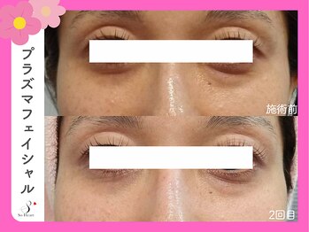 ソーハート(So Heart)/目元のしわ改善☆トーンアップ☆