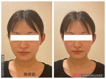 小顔コルギ専門店 フェルーシュ 成田駅前店(Feruche)/サーモシェイプ結果写真