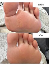 ケアプラス(care plus)/足裏角質ケア