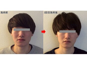 整体院プラス/小顔矯正モニター