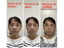 ハーボプラス(THE HEARBO plus)/施術例７