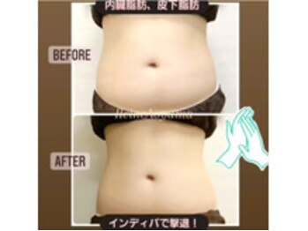 レーヌ青山(Reine Aoyama)/【施術】インディバ内蔵ケア