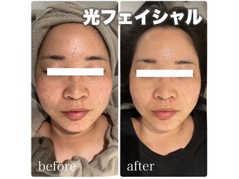 ネオファースト 大阪福島店(NeoFirst)/シミケア#毛穴#毛穴洗浄#福島