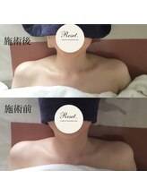 リセット(Reset.)/深層筋リンパ／ before → after