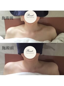 リセット(Reset.)/深層筋リンパ/ before → after