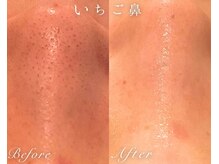 ソワ(SOWA)/毛穴ケア
