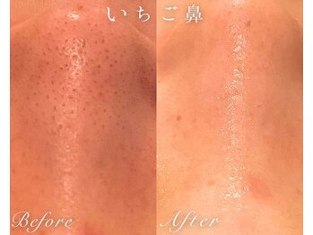 ソワ(SOWA)/毛穴ケア