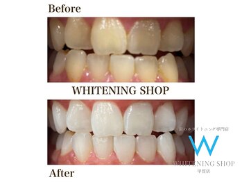 ホワイトニングショップ 甲賀店/Before&After『ホワイトニング』