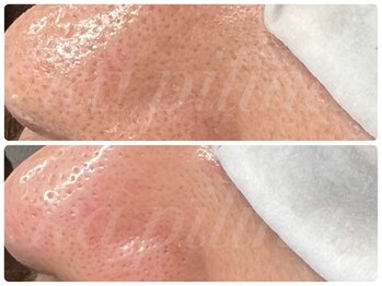 カピリナ(ka pilina)/1回でこの変化！ツヤ肌へ★