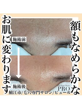 ピュール 鯖江店(PUR)/毛穴/毛穴ケア/毛穴洗浄