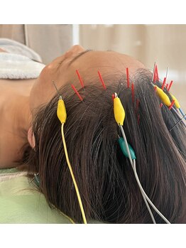 久心宝鍼灸院/とにかく頭鍼