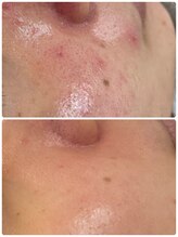 ティンクルホワイト 橿原店/剥離しないハーブピーリング