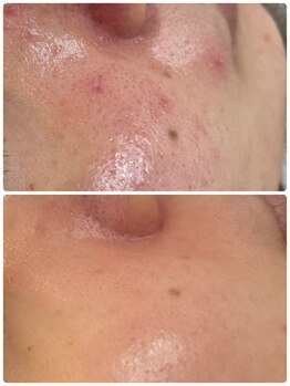 ティンクルホワイト 橿原店/剥離しないハーブピーリング