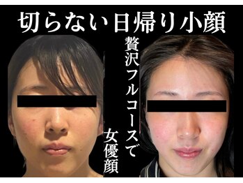 リノン(LIINON)/切らない日帰り小顔!