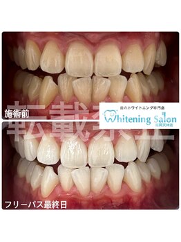 ホワイトニングサロン 福岡天神店/ホワイトニング
