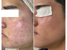 ハクビューティー(HAKU BEAUTY)/圧倒的肌質改善