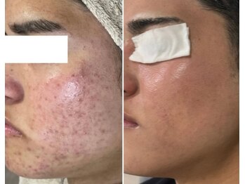 ハクビューティー(HAKU BEAUTY)/圧倒的肌質改善