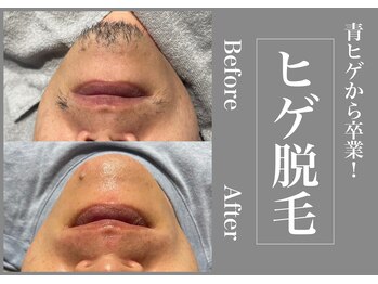 さくら通りクリニック/青髭から卒業!ヒゲ脱毛