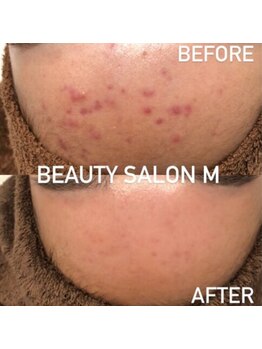 エム(M)/おでこのぽつぽつニキビケア