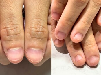 アリエ(allie)の写真/自分の爪が好きになる深爪矯正！長年悩みの種だった爪コンプレックスから卒業しませんか？