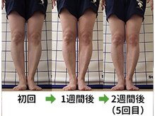 ひかわ整骨院 熊本巻き爪センター/Ｏ脚矯正 ビフォーアフター