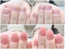 ネイルサロン オー(Oh!)/劇 的☆深爪改善！before→after