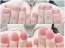 劇 的☆深爪改善！before→after