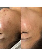 ウィンウィン 新山口店(Win Win)/ニキビケアに最適