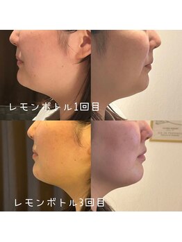 サロン ド モミカル(salon de momikaru)/レモンボトル