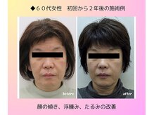 お顔全体の浮腫みがとれ、スッキリ小顔になりました。