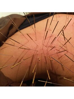 ハリドコロケン(KEN)/肩こり