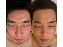 ラテプラス(LATEE＋)/内側からもケア【20代】