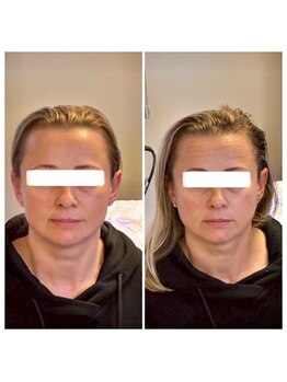 アップライン(Up Line)/高濃度炭酸の施術前/施術後