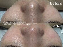 ナチュールムーン(Nature moon.)の雰囲気（毛穴の奥まで詰まりを落として、すっきりクリアなお肌へ☆）