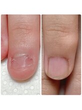 スマイルニコ(smile nico)/子供さんの深爪