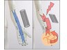 【バネ指でお悩みの方】指を曲げる筋肉が縮んだ状態のまま固まっているかも？