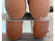 カシェット 広島店(Cachette)/30代女性☆足裏角質ケア90分