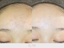 ルーミー 南青山(LUME)/ニキビケア／卵肌／陶器肌