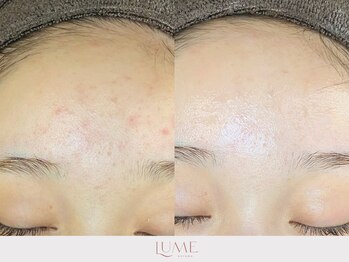 ルーミー 南青山(LUME)/ニキビケア／卵肌／陶器肌