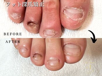 プラスワン(+1)の写真/【もっと早く来ればよかった…】深爪のコンプレックスは＋1で当日に改善♪自爪育成で美しい足先に☆