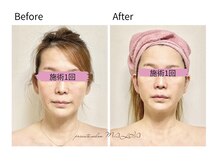 マリア(MALIA)/小顔・二重あご改善・南森町
