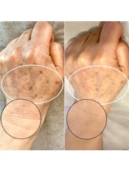 ル ボヌール/腕のおシミも