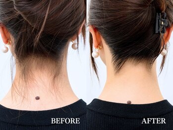 ミース 広島中央店/うなじ脱毛◆ビフォーアフター