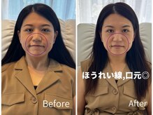 ミラ 中央林間(mira)/小顔 毛穴 ほうれい線 ハリ弾力