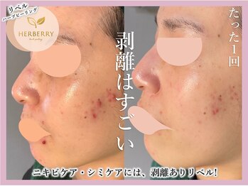 ハーバリー ハーブピーリング 金山店(HERBERRYハーブピーリング)/名古屋ハーブピーリングHERBERRY