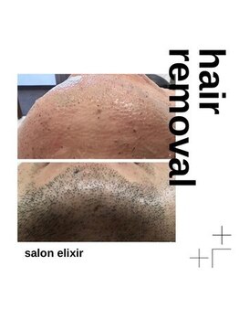 ブリッジ(BRIDGE)/男性ヒゲ脱毛ビフォーアフター