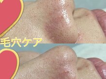 ニコ アンド キャンディー(Nico.&Candy)/男女大人気☆毛穴ケア◎