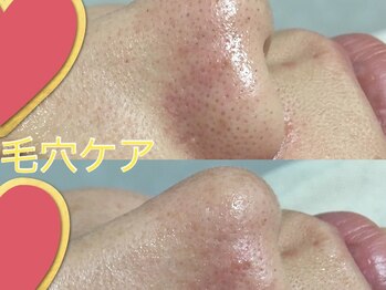 ニコ アンド キャンディー(Nico.&Candy)/男女大人気☆毛穴ケア◎