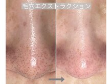 カミーシャ(KaMi-Sha)/【40代女性】自己流毛穴で悪化